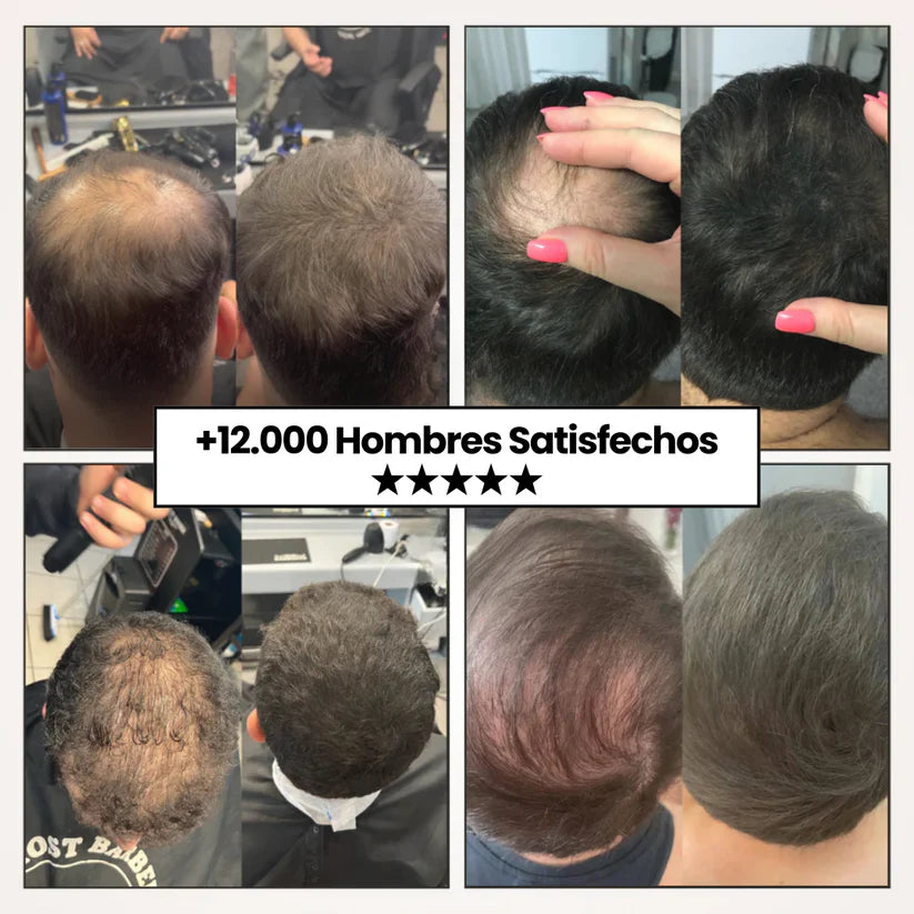 Sculpix™️ | Dile Adiós a las entradas, canas y calvicie