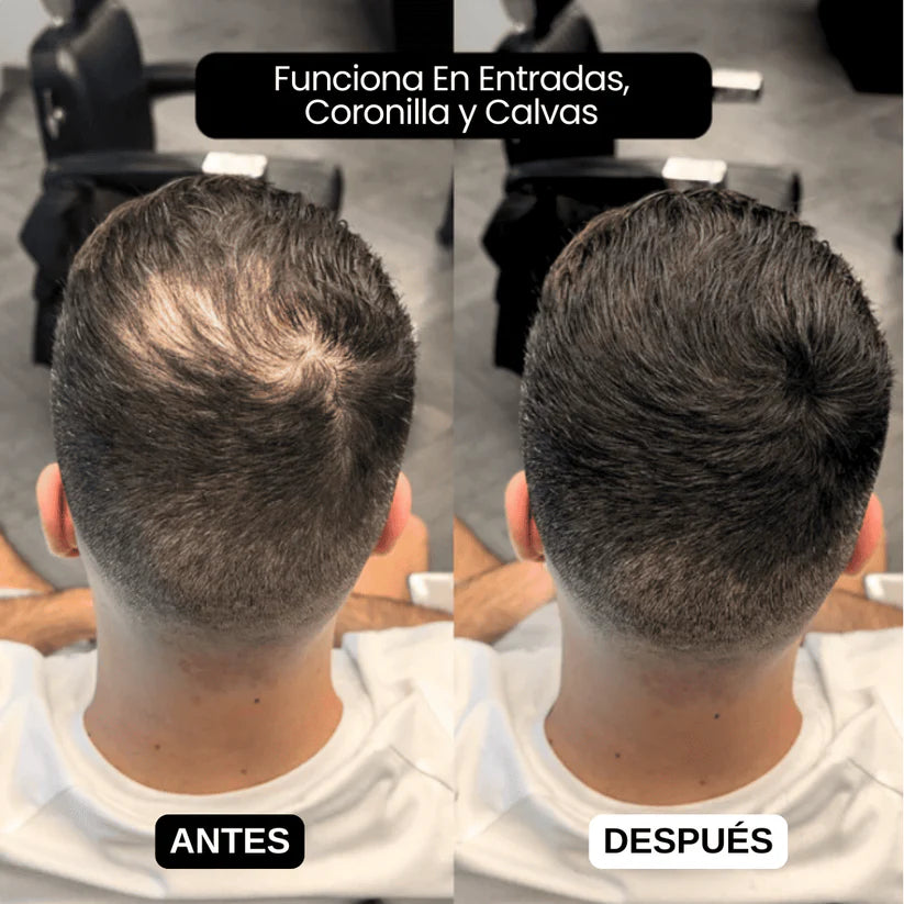 Sculpix™️ | Dile Adiós a las entradas, canas y calvicie